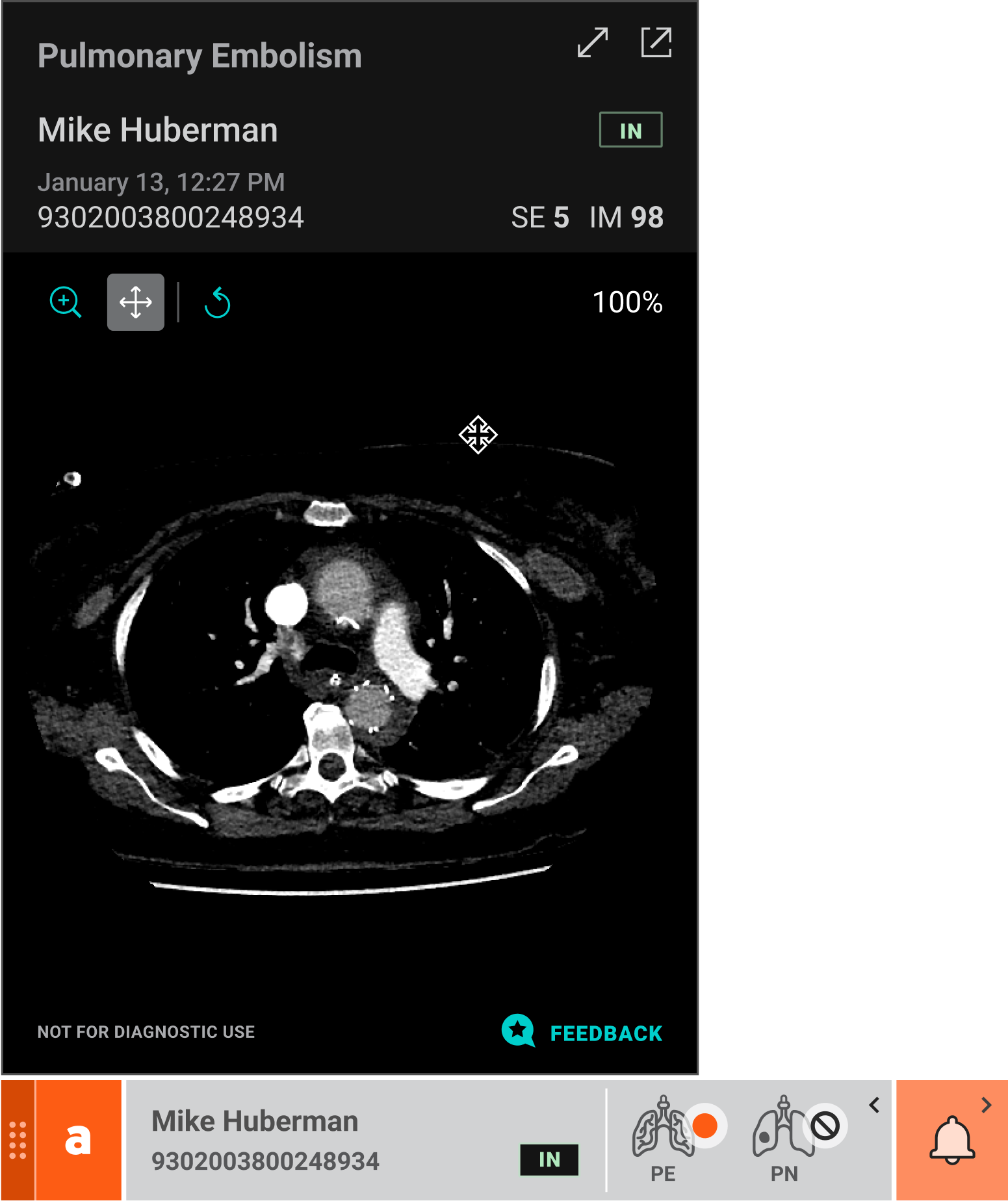 **Contextual view (with PACS)** • Indications on findings + new alert